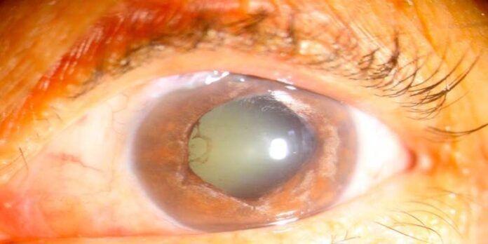 Ojo con glaucoma Ojo con glaucoma