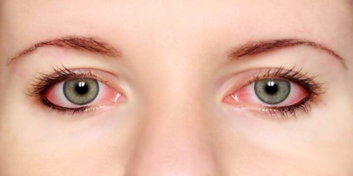 Ojos con conjuntivitis Ojos con conjuntivitis